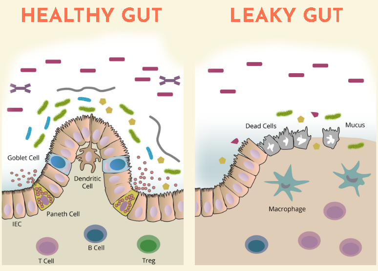 leaky gut microbiome vs healthy gut microbiome