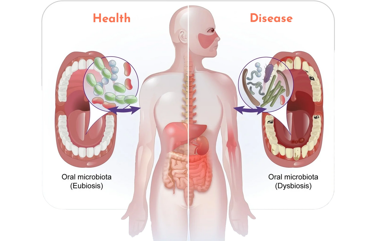 Dysbiosis of oral microbiome